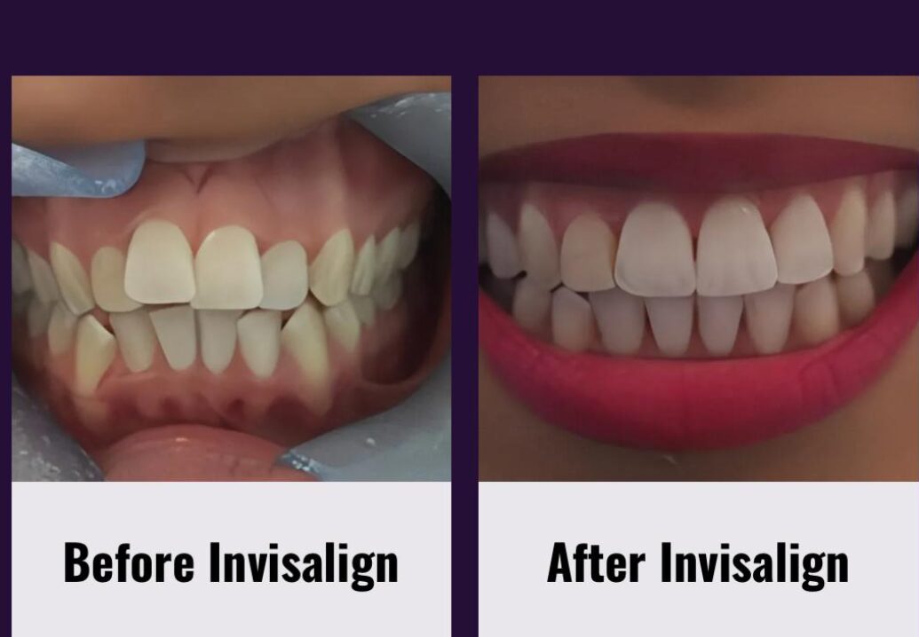 Invisalign